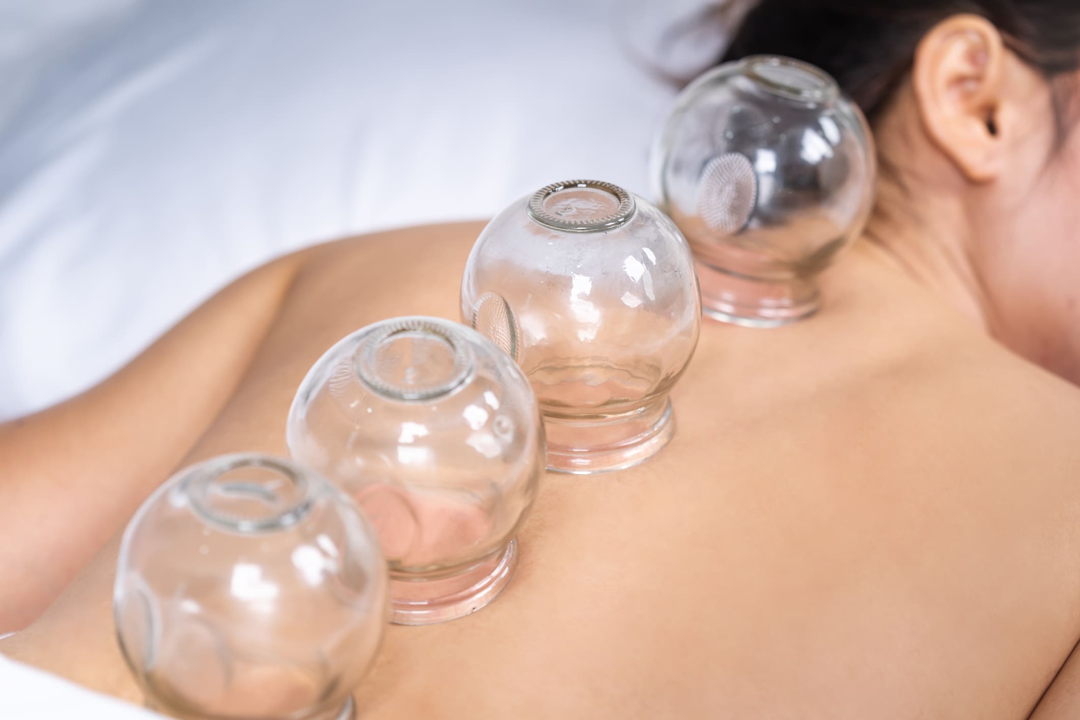 Cupping therapy on a person's back.